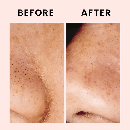 Blackhead Removal Essence