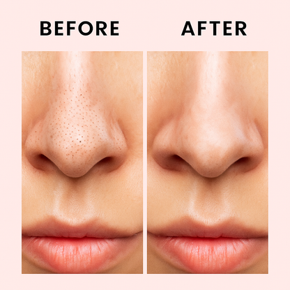 Blackhead Removal Essence
